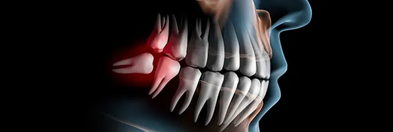 コラム:親知らず抜歯は専門医に!藤尾歯科医院の口腔外科専門医・認定医がしっかりサポート